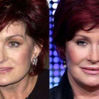 Sharon Osbourne Plastic Surgery 2022 Before and After! - Her 'Horrendous' Facelift