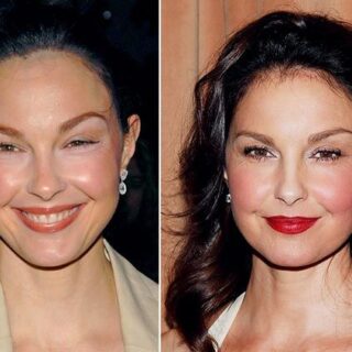 Ashley Judd plastic surgery