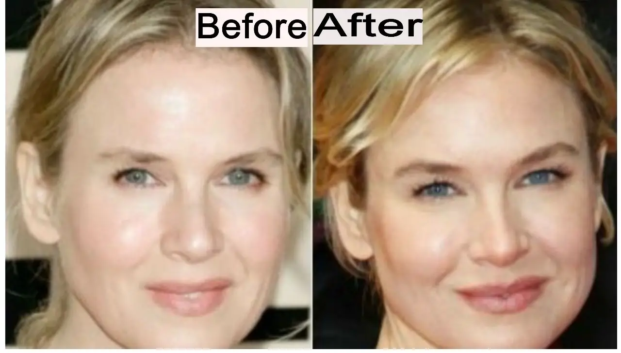Renee Zellweger Plastic Surgery Reddit - Before & After