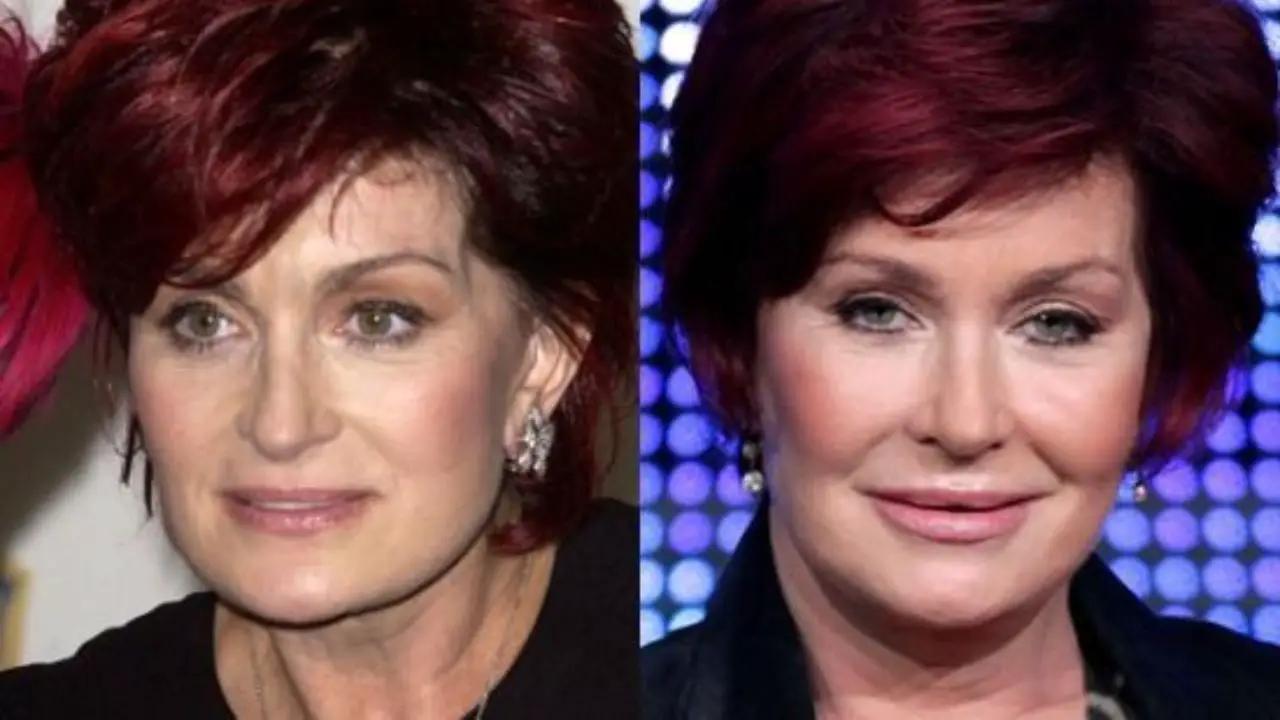 Sharon Osbourne Plastic Surgery 2022 Before and After! - Her 'Horrendous' Facelift